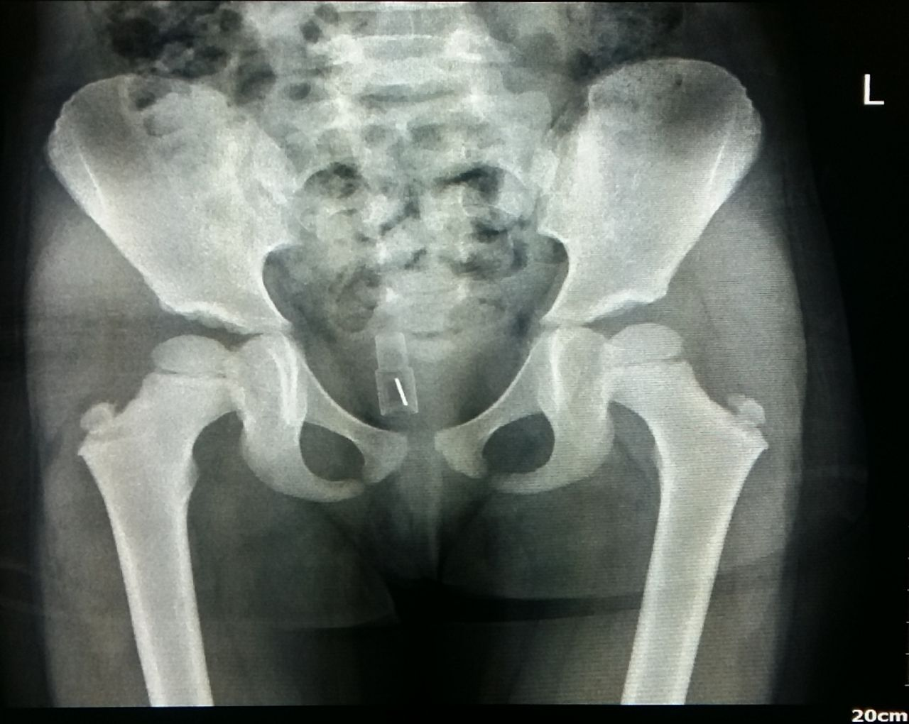 Vaginal foreign body